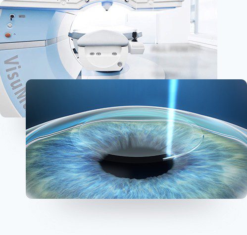 ReLEx smile Kosten mit Femtosekundenlaser VisuMax